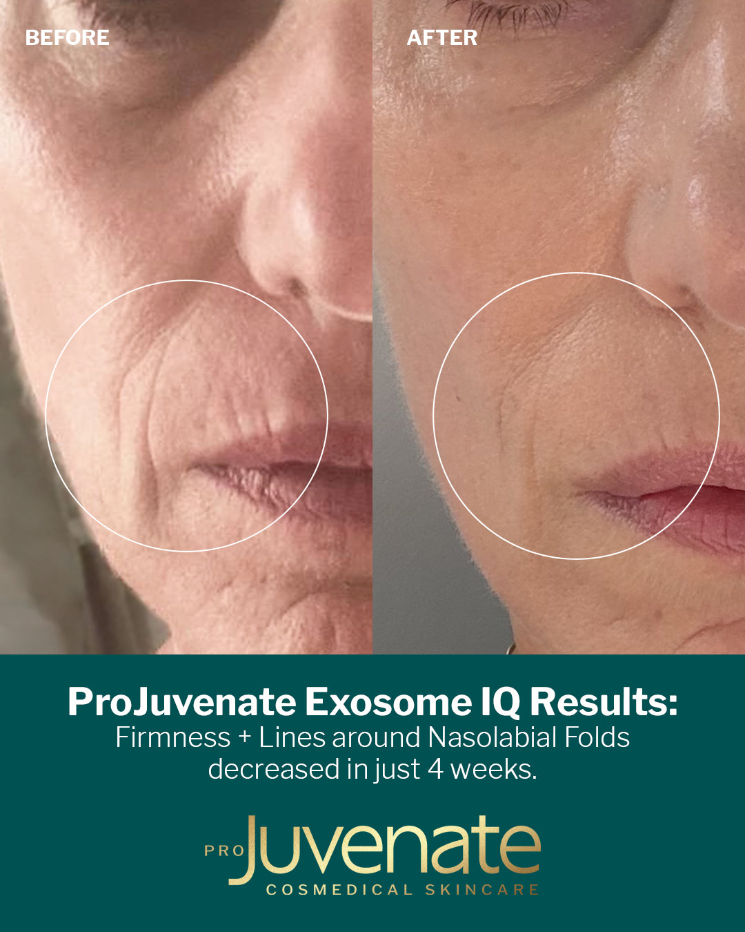 Exosome IQ with 180,000+ Bio-Needles 30ml